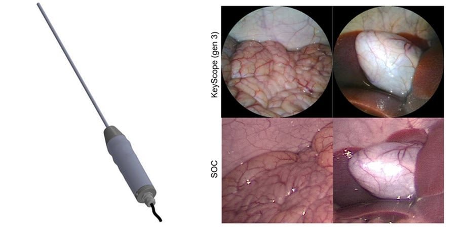 (Left) A computer-aided design rendering of the low-cost laparoscope, called the KeyScope. Keyscope enables high resolution surgical imaging with a wide field of view, color accuracy, and low distortion, resulting in Keyscope images (right) comparable to a standard (SOC) laparoscopic device. Courtesy of Barnes et al., doi 10.1117/1.BIOS.2.2.022302.